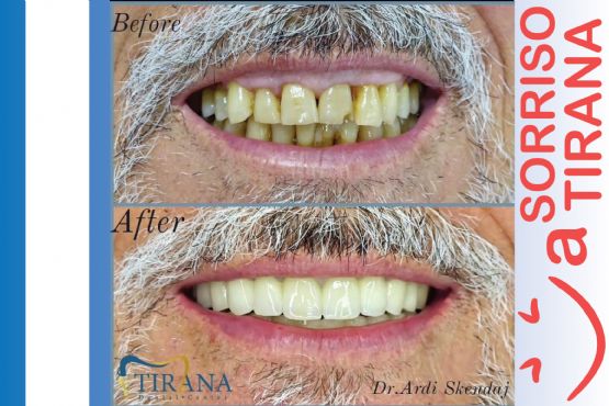 Dentisti à Tirana, Turismo Dentale in Albania con Turista Sorridente dentista albania, clinica dentale in albania, dentisti albania prezzi